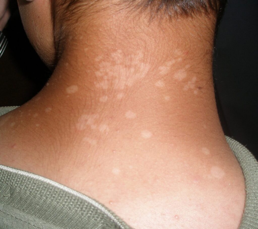 Do you have white spot in skin? Pityriasis versicolor; causes and ...