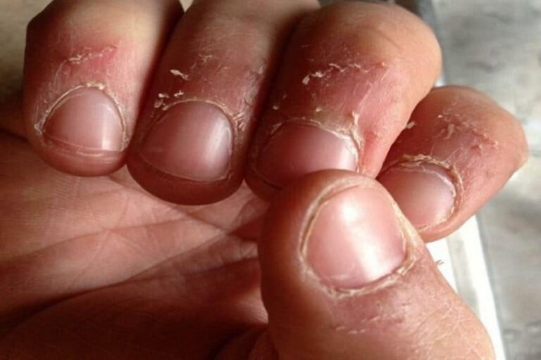 skin-peel-medicalbasic