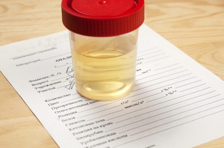 Sugar in urine; From which level of blood glucose excreted in urine