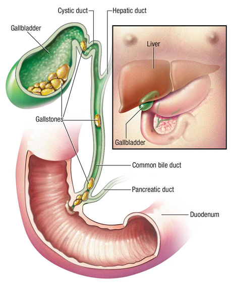 cholecystectomy-medicablbasic