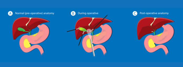cholycystectomy-medicalbasic